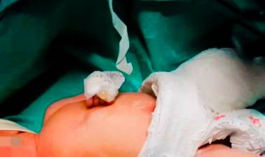 UNA GINECÓLOGA DE VILLA ÁNGELA LE QUEBRO LA PIERNITA A UN BEBE MIENTRAS REALZABA LA CESÁREA